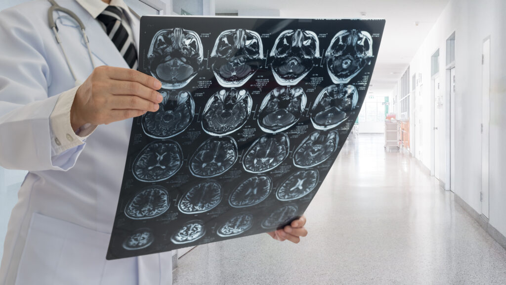 A doctor holds and examines multiple brain MRI scans in a well-lit hospital corridor, with medical doors and equipment visible in the background.