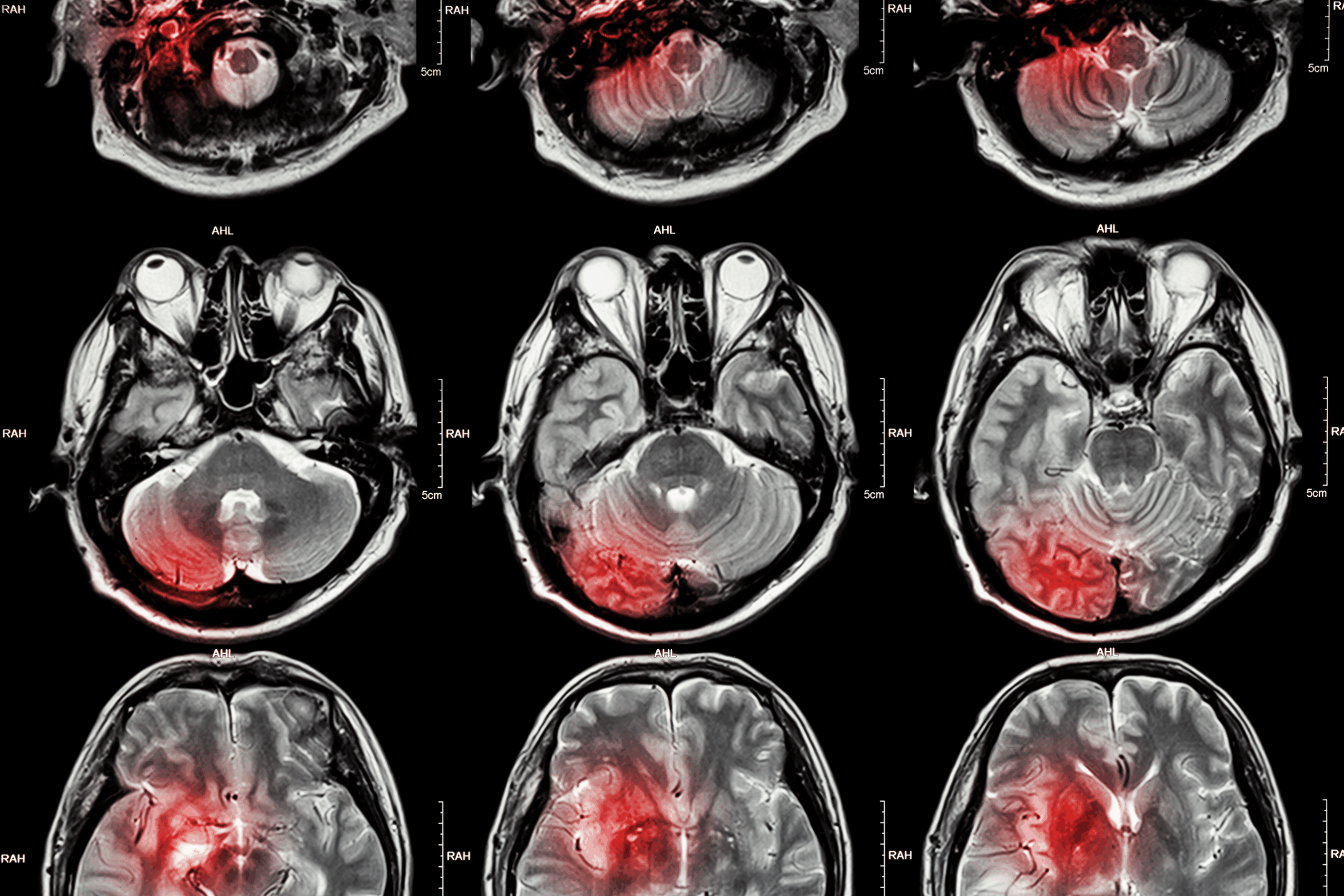 neuroinflammation brain scans