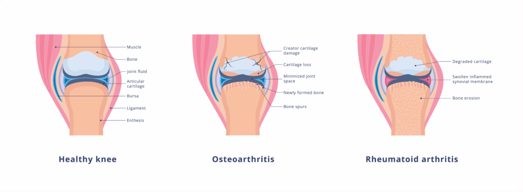 knee conditions